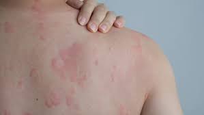 ANTI ALLERGIES